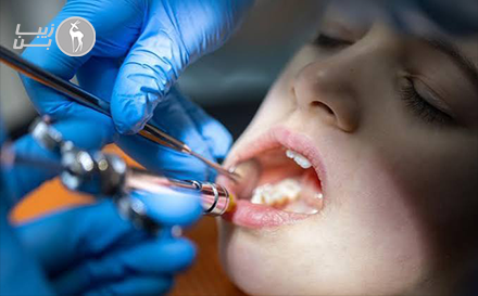 عصب‌کشی دندان چهار کانال با تخفیف ویژه در سعادت‌آباد | دندانپزشکی لوکا